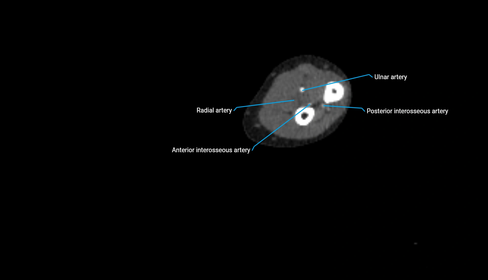 CTA upper limb axial cross sectional anatomy labelled image 157 (2).webp